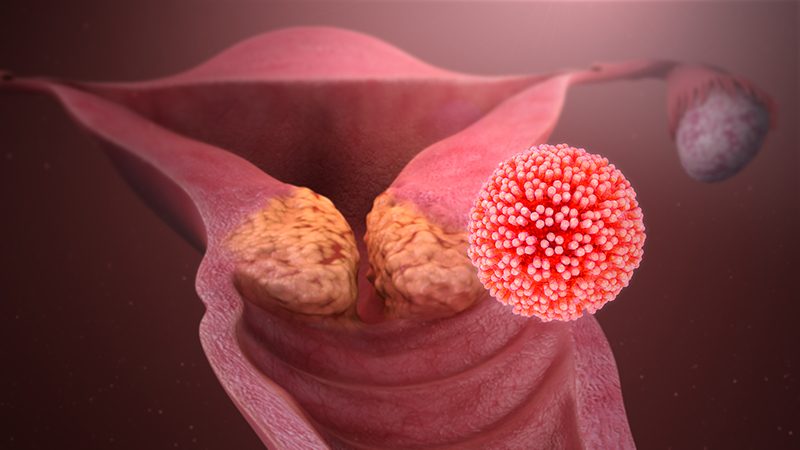 HPV 