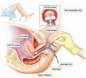 HPV